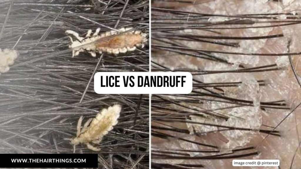 Lice vs Dandruff