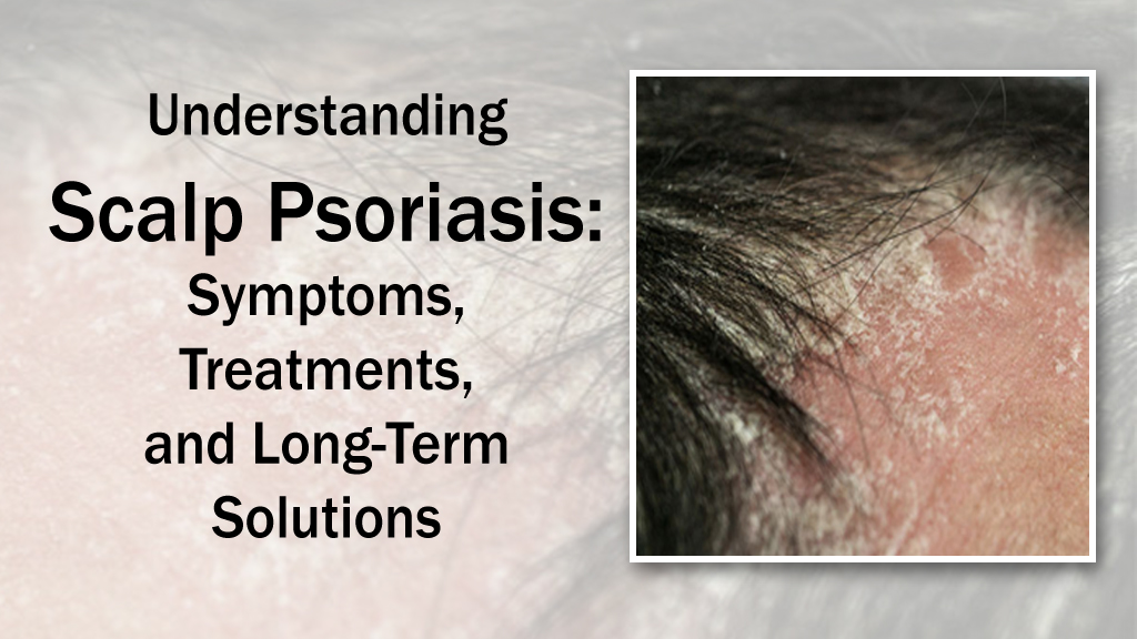 scalp psoriasis